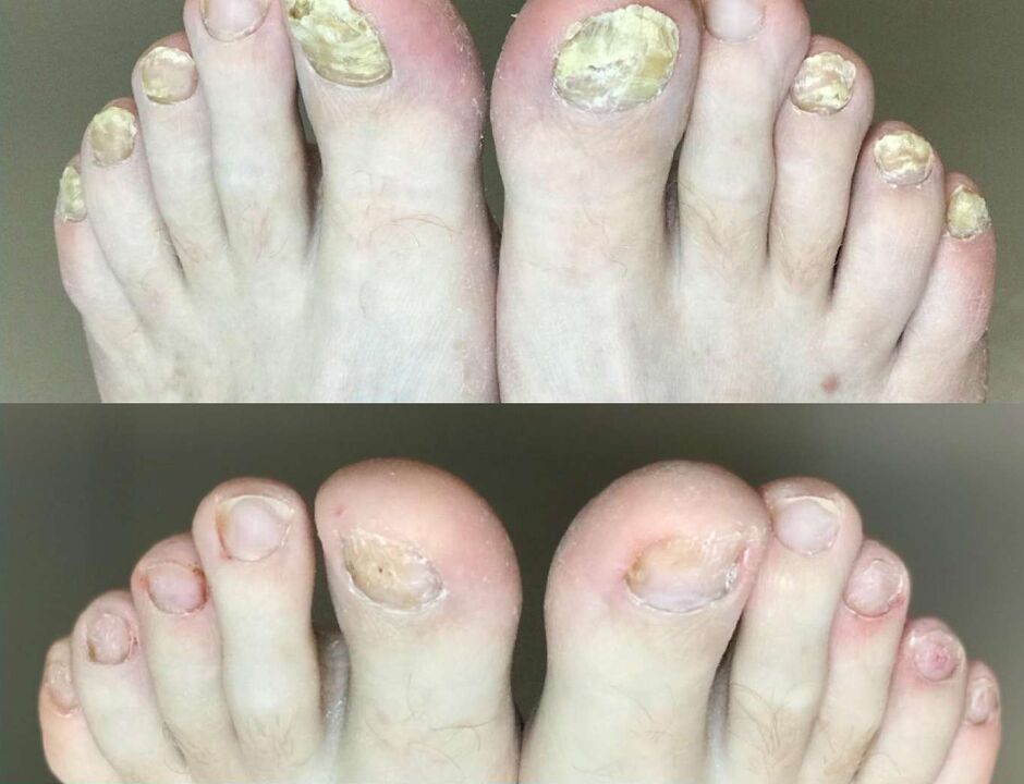 Voor en na behandeling, de Fungus Promisil Cream