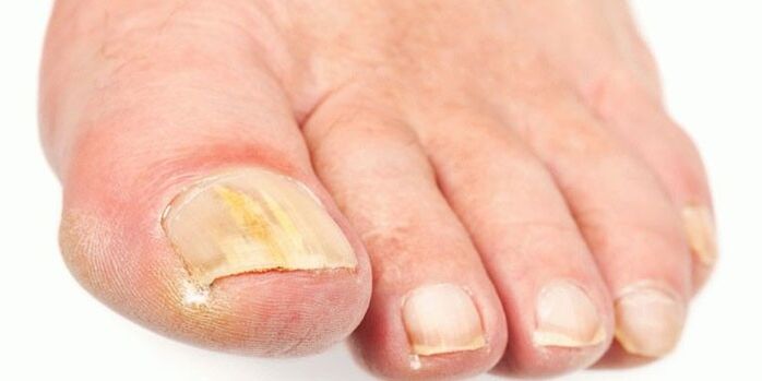 Effectieve producten van nagelschimmel