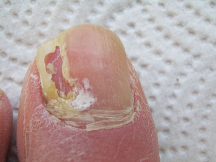 Bij onychomycose treedt vervorming van de nagelplaat op