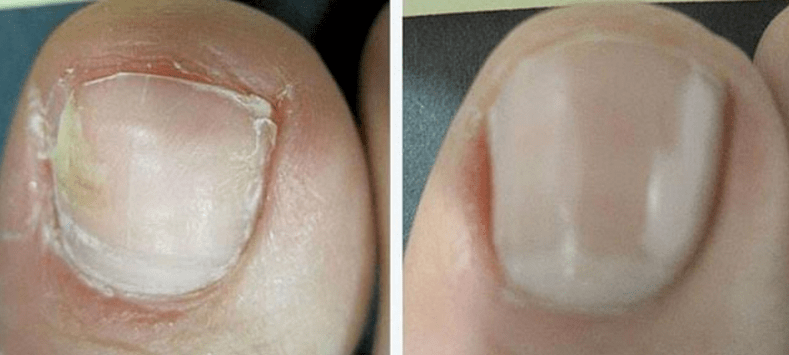 Nagel voor en na schimmelbehandeling