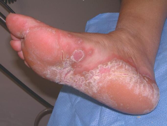 Voet aangetast door schimmelinfectie