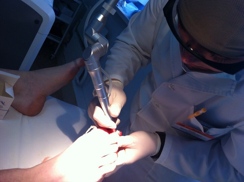 Laserbehandeling van mycosis